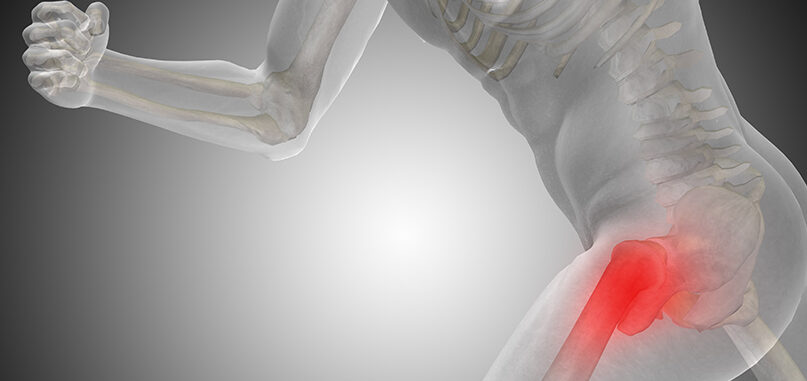 Ολική Αρθροπλαστική Ισχίου με πρόσθια προσπέλαση AMIS