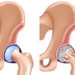 Φυσιολογικό ισχίο και οστεοαρθρίτιδα