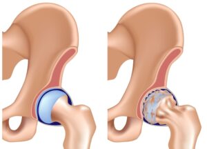 Φυσιολογικό ισχίο και οστεοαρθρίτιδα