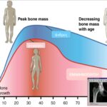 Οστική πυκνότητα και κατάγματα ισχίου