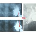 Αναθεώρηση κοτύλης αρθροπλαστικής ισχίου