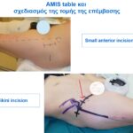 Bikini τομή σε αρθροπλαστική AMIS