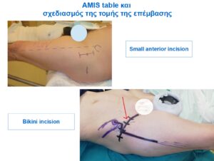 Bikini τομή σε αρθροπλαστική AMIS