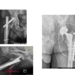 Αναθεώρηση σε αποτυχημένο χειρουργείο κατάγματος ισχίου