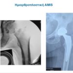 Ημιαρθροπλαστική AMIS σε υποκεφαλικό κάταγμα ισχίου