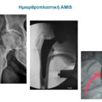 Ημιαρθροπλαστική ισχίου AMIS με πολύ μικρή τομή