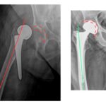 Αποτυχία αρθροπλαστικής AMIS