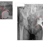 Επιπλοκή αρθροπλαστικής AMIS