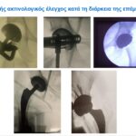 Ακτινοσκόπηση κατά την εκτέλεση μεθόδου AMIS