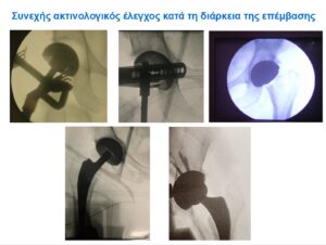 Ακτινοσκόπηση κατά την εκτέλεση μεθόδου AMIS