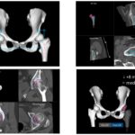 Είδος ρομποτικής αρθροπλαστικής AMIS