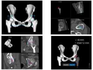 Είδος ρομποτικής αρθροπλαστικής AMIS