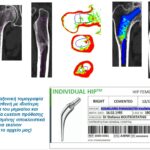 Εξατομικευμένη αρθροπλαστική ισχίου