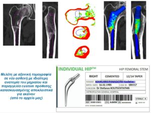 Εξατομικευμένη αρθροπλαστική ισχίου