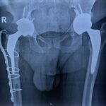 Custom made vs AMIS αρθροπλαστική ισχίου