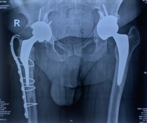 Custom made vs AMIS αρθροπλαστική ισχίου