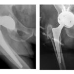 Αναθεώρηση αρθροπλαστικής ισχίου με κλειδούμενη κοτύλη