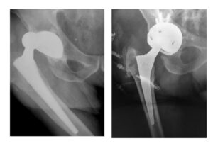 Αναθεώρηση αρθροπλαστικής ισχίου με κλειδούμενη κοτύλη