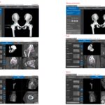 Ταυτόχρομη ρομποτική αρθροπλαστική ισχίων AMIS