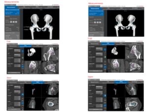 Ταυτόχρομη ρομποτική αρθροπλαστική ισχίων AMIS