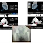 Ταυτόχρομη ρομποτική αρθροπλαστική ισχίων AMIS