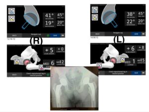 Ταυτόχρομη ρομποτική αρθροπλαστική ισχίων AMIS