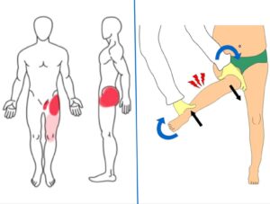 Πόνος οστεαρθρίτιδας ισχιου