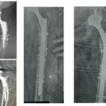 Αναθεώρηση μηριαίας πρόθεσης