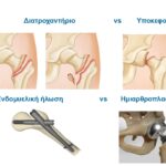 Τύποι καταγμάτων ισχίου