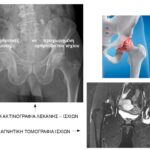Ακτινογραφία και μαγνητική στην αρθρίτιδα του ισχίου
