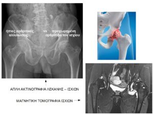 Ακτινογραφία και μαγνητική στην αρθρίτιδα του ισχίου