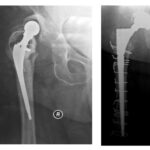 Ολική αναθεώρηση αρθροπλαστικής ισχίου