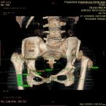 Τρισδιάστατη αξονική τομογραφία ισχίου