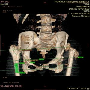 Τρισδιάστατη αξονική τομογραφία ισχίου