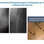 Κλειστή ενδομυελική ήλωση σε διατροχαντήριο κάταγμα