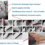 Ήλωση διατροχαντηρίου κατάγματος