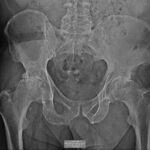 Ακτινογραφία τελικού σταδίου οστεοαρθρίτιδας του ισχίου