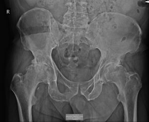 Ακτινογραφία τελικού σταδίου οστεοαρθρίτιδας του ισχίου