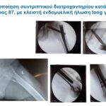 Χειρουργείο για κάταγμα ισχίου