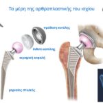 Προθέσεις στην Αρθροπλαστική ισχίου AMIS