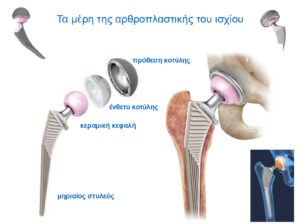 Προθέσεις στην Αρθροπλαστική ισχίου AMIS