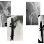 Συνδυασμένη ήλωση με κυκλοτερή σύρματα μηριαίου