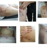 Αρθροπλαστική AMIS με πολύ μικρή τομή