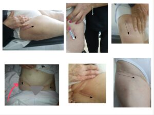 Αρθροπλαστική AMIS με πολύ μικρή τομή