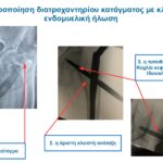 Κλειστή ήλωση σε διατροχαντήριο κάταγμα