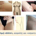 Αρθροπλαστική AMIS με πολύ μικρή τομή