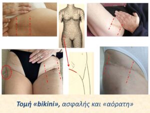 Αρθροπλαστική AMIS με πολύ μικρή τομή