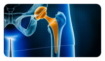 Αρθροπλαστική ισχίου AMIS