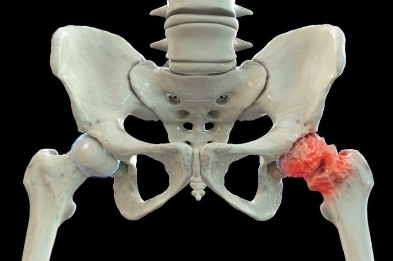 Οστεοαρθρίτιδα ισχίου