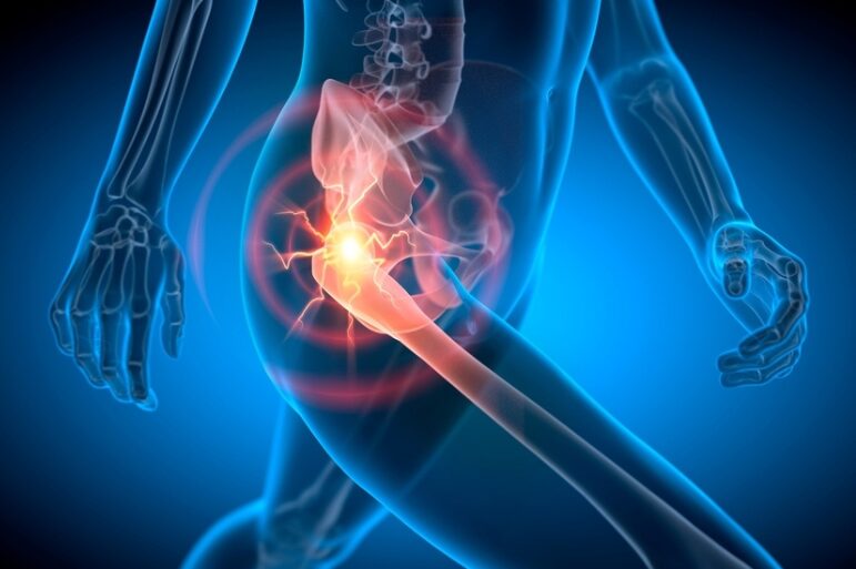Πόνος στο Ισχίο